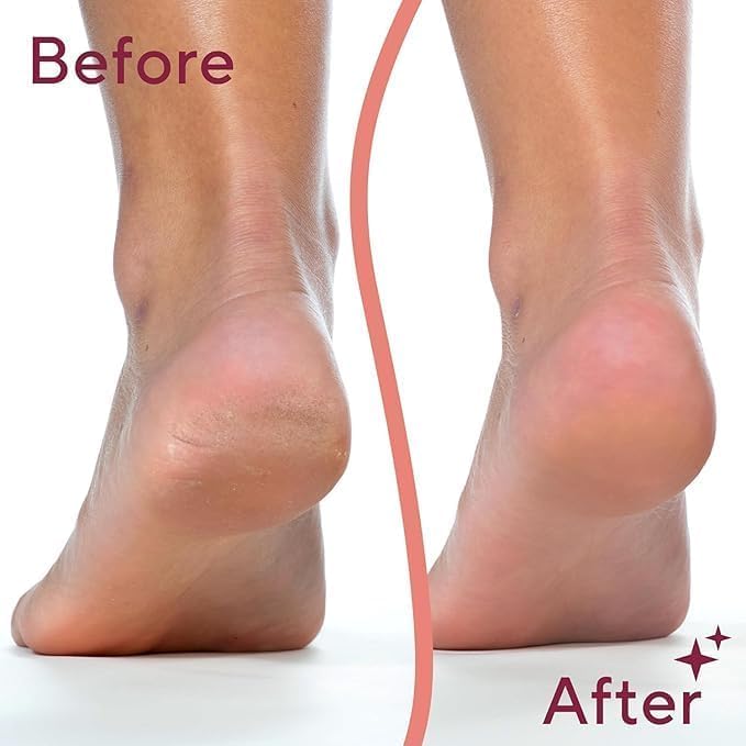Electric Foot Callus Remover (Feet Dead Skin Remover) image 6